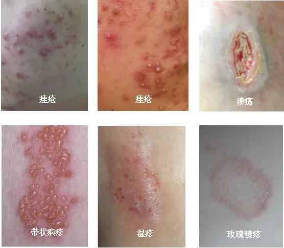 太阳成集团tyc4633皮肤科引进红蓝光治疗仪和二氧化碳激光治疗仪